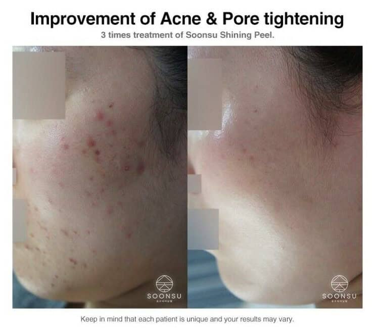 Buy Soonsu Shining Peel Online | Wholesale Pricing