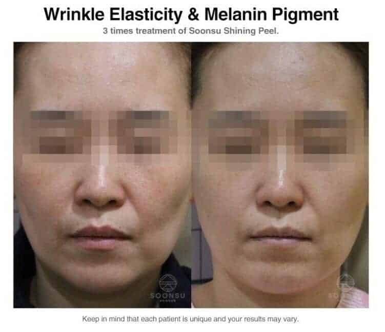 Buy Soonsu Shining Peel Online