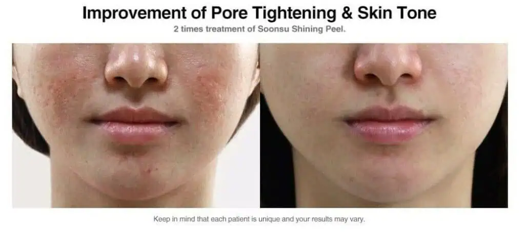 SOONSU AQUA CREAM & SHINING PEEL セット SOONSU 35% TCA SHINING PEEL | LUX LAB