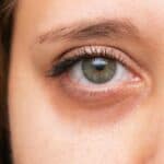 Eliminate bags under the eyes