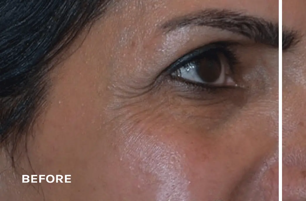 exosomes-smoothening-out-wrinkles