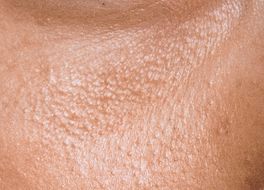 skin aging
